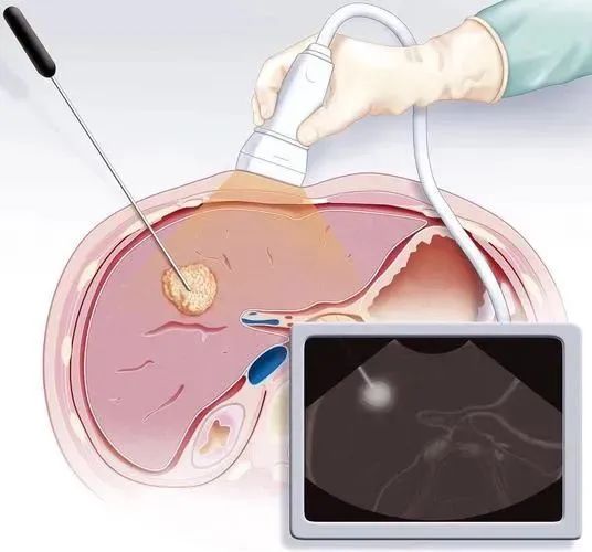 新技术新项目丨超声介入——实现肿瘤的精准微创治疗!